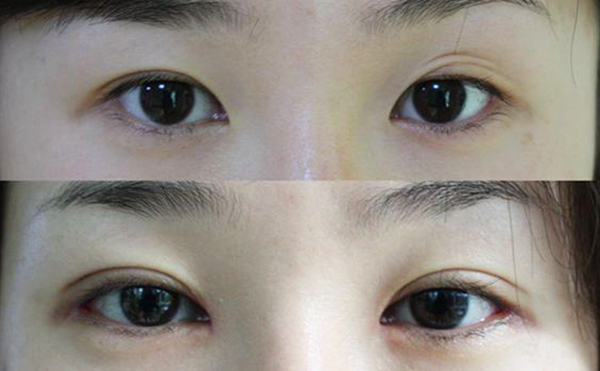 哪個(gè)季節(jié)做雙眼皮好?術(shù)后有什么需要注意的?