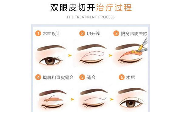 割雙眼皮改善腫眼泡有什么優(yōu)勢(shì)?術(shù)后有什么并發(fā)癥?