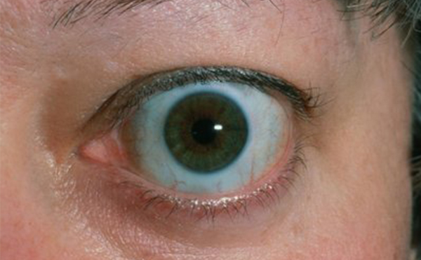 單側(cè)眼球突出什么原因?矯正需要多少錢?