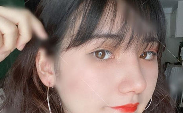 假體取出來鼻子會(huì)變形嗎?