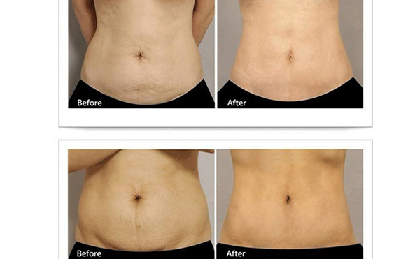 腹壁成型術(shù)會留疤嗎？