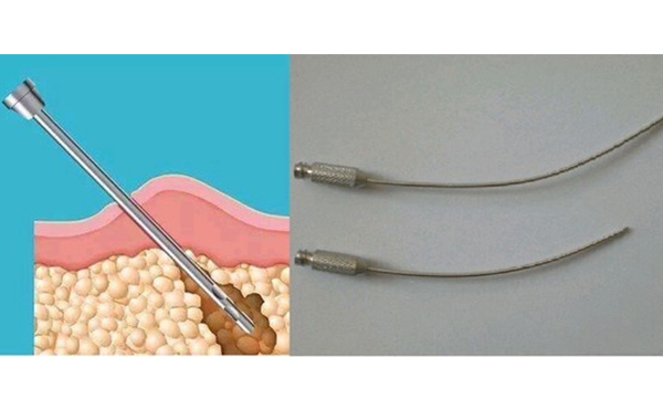 面部吸脂效果怎么樣?術后會不會留疤?