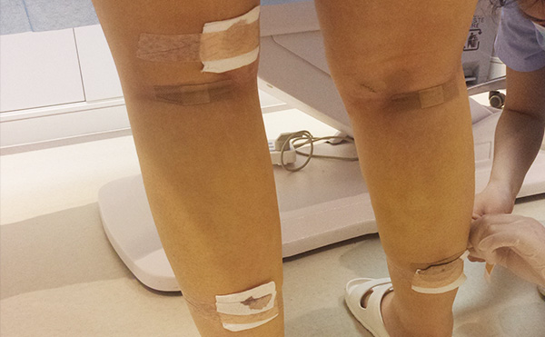 腿部吸脂的部位有哪些？