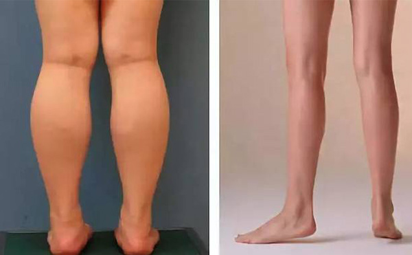 腿部吸脂疼不疼？