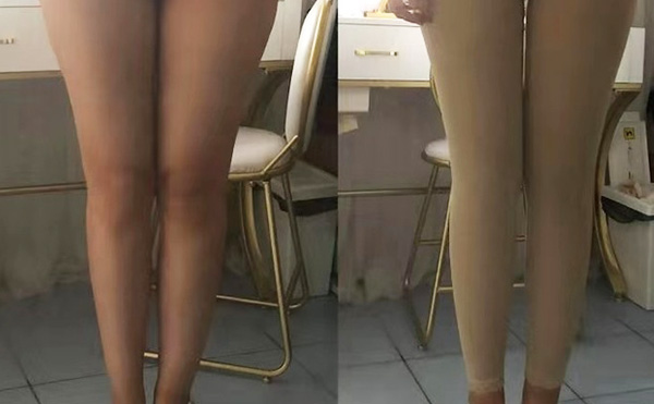 環(huán)吸抽脂疼不疼？