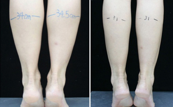 瘦腿針可以維持多長時間？