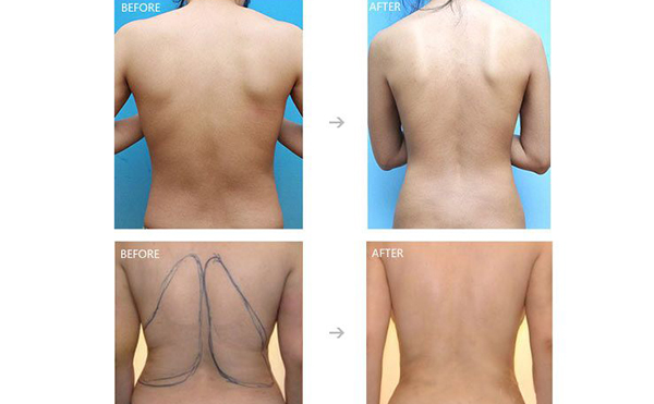 背部吸脂是怎么做的?效果怎么樣?