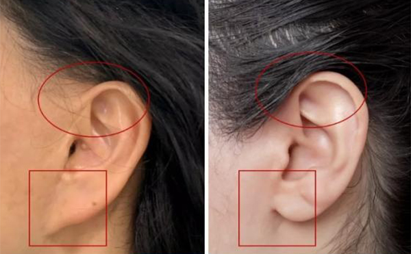 拉皮手術的危害有哪些?術前要注意什么?