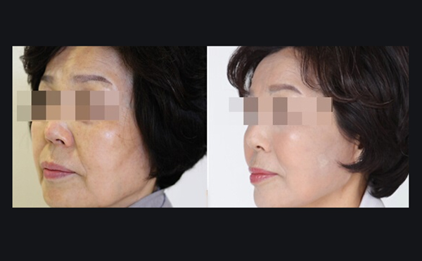 電波拉皮適合哪些人？