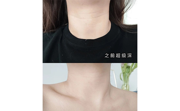 激光去頸紋適合哪些人？