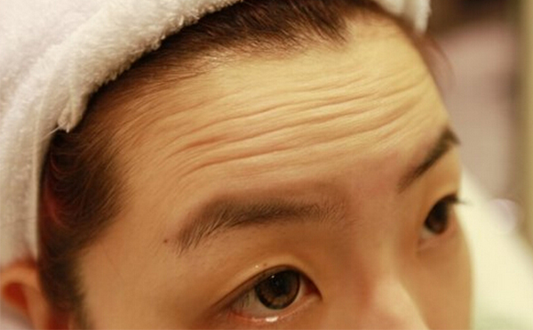 抬頭紋是怎么形成的？