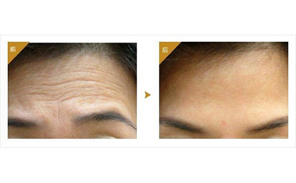 注射玻尿酸注意事項有哪些？