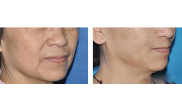 筋膜懸吊除皺適合哪些人？