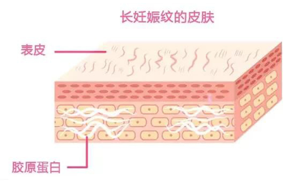 妊娠紋是怎么形成的？