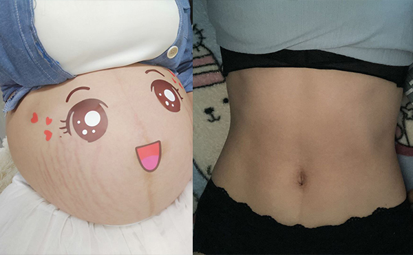 電波拉皮去除妊娠紋效果怎么樣？