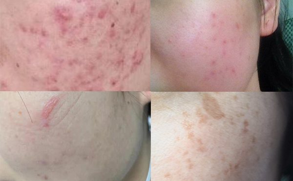 光子嫩膚安全嗎？