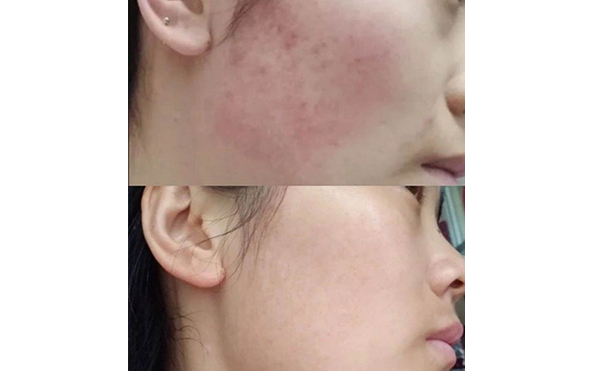 彩光嫩膚會讓皮膚變薄嗎？