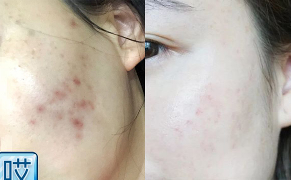 激光美白能安全嗎？