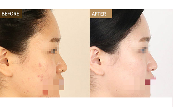 激光美白適合哪些人？