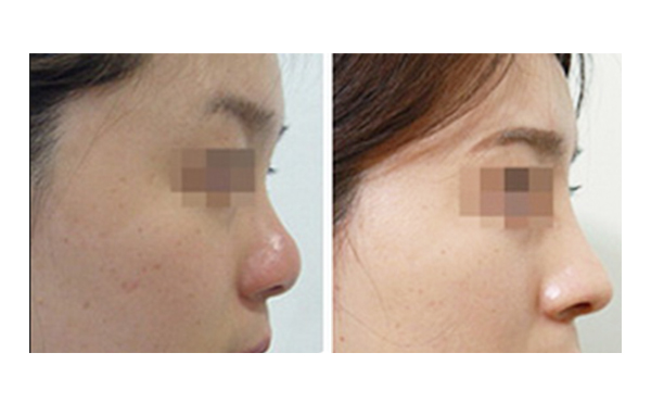 美白針和激光美白怎么選？