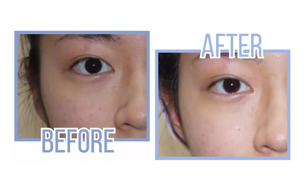 激光美白做幾次有效果？