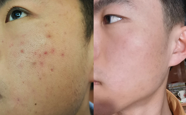 白瓷娃娃每次治療間隔多久？