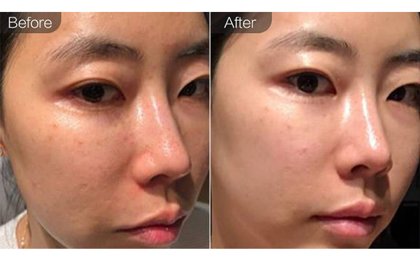 e光嫩膚是什么？