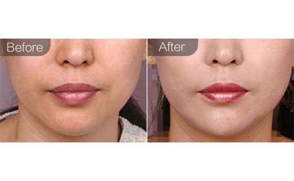 e光嫩膚有什么優(yōu)勢(shì)？