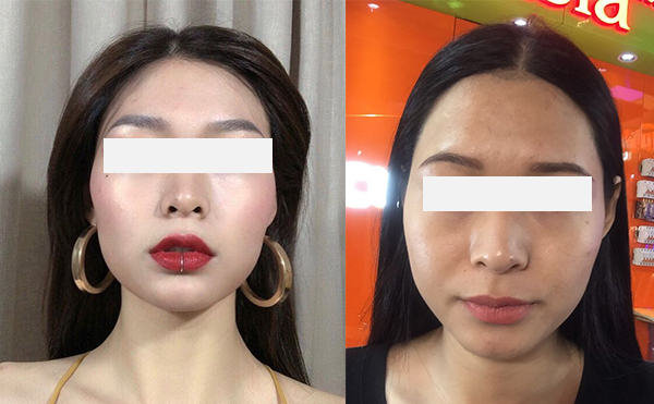 激光脫發(fā)際線效果怎么樣？