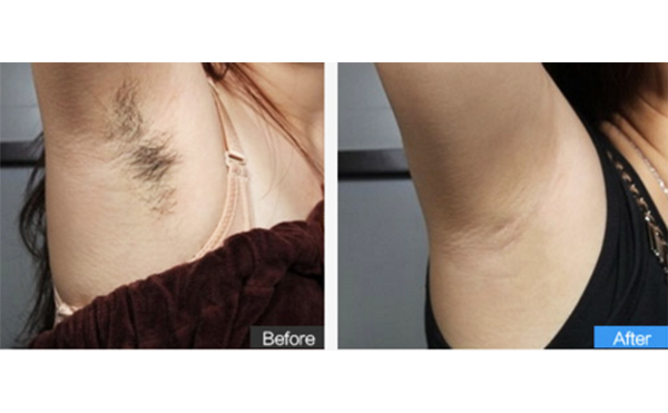 激光脫腋毛后多久能見效？