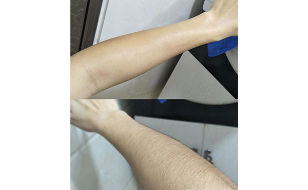 冰點(diǎn)手臂脫毛