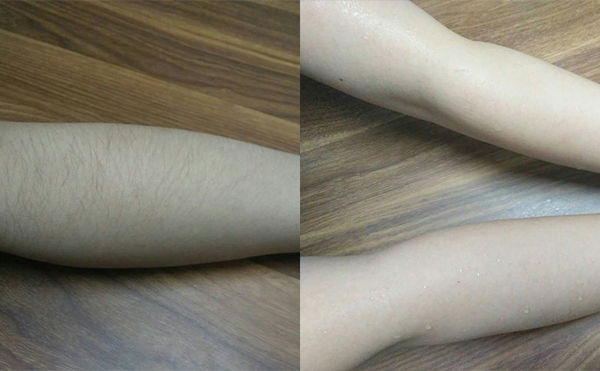 冰點手臂脫毛會傷害皮膚嗎？
