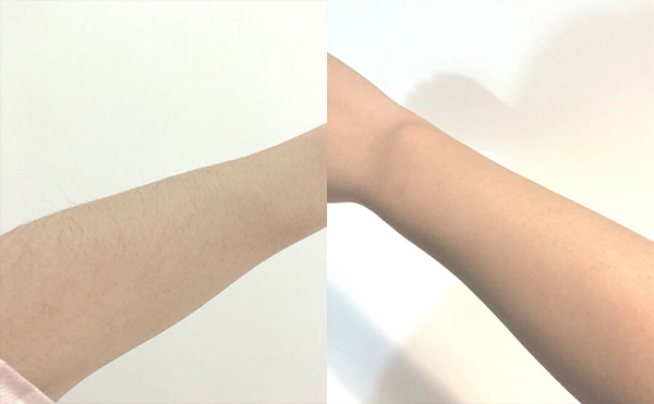 冰點(diǎn)手臂脫毛