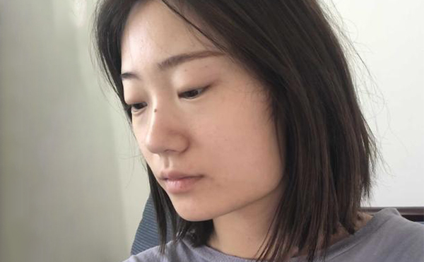 下頜角整形適宜人群有哪些？