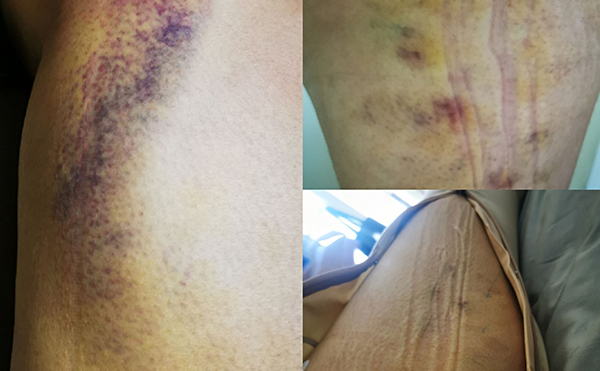 打瘦腿針有什么后遺癥嗎？