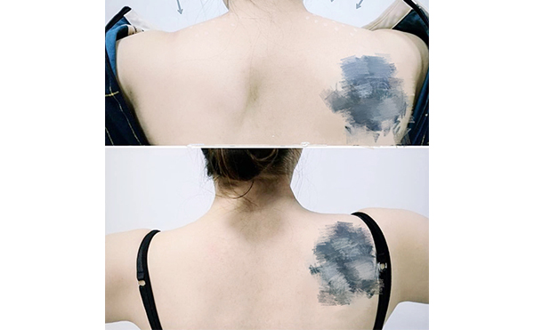 瘦肩針能維持多久？