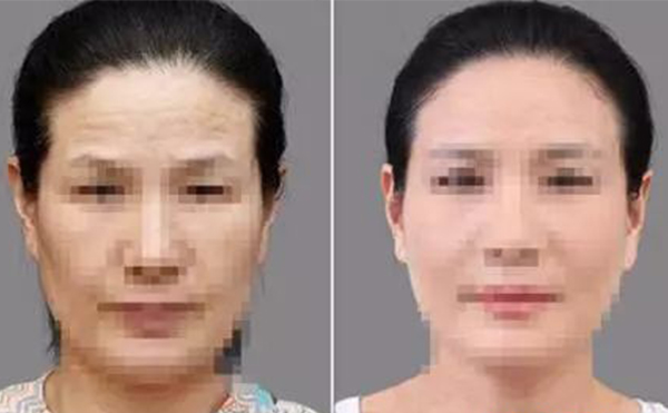 激光除皺有什么優(yōu)勢？