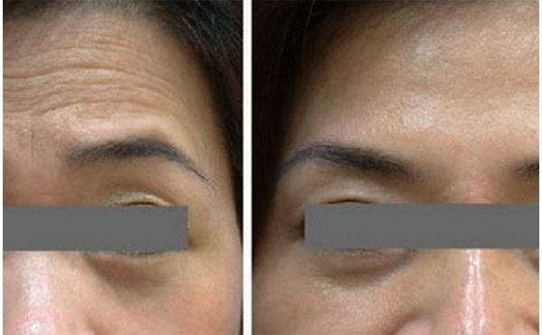 玻尿酸去抬頭紋能維持多久?