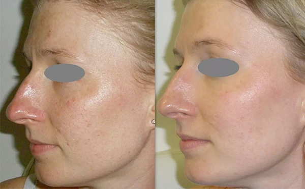 光子嫩膚價格受哪些因素影響？