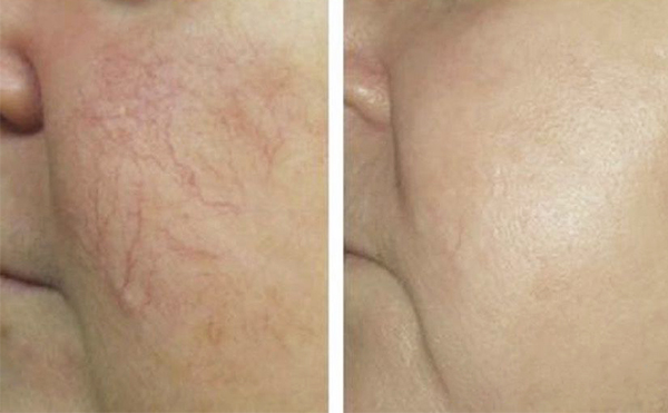 彩光嫩膚疼不疼？