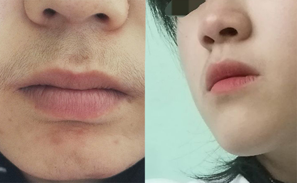 面部激光脫毛有什么優(yōu)勢(shì)？