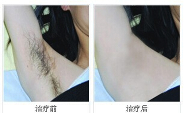 冰點(diǎn)脫腋毛安全嗎？