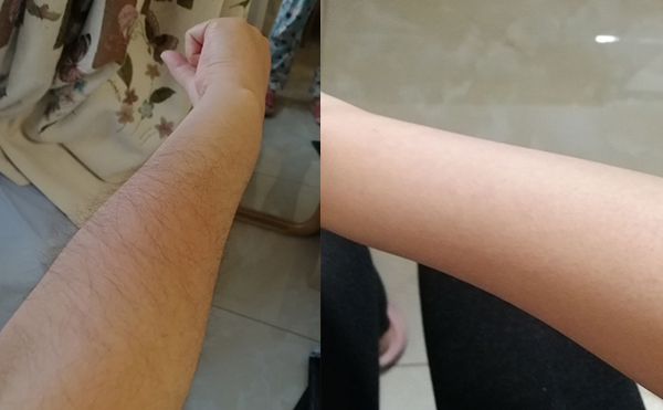 光子手臂脫毛幾次能脫完?