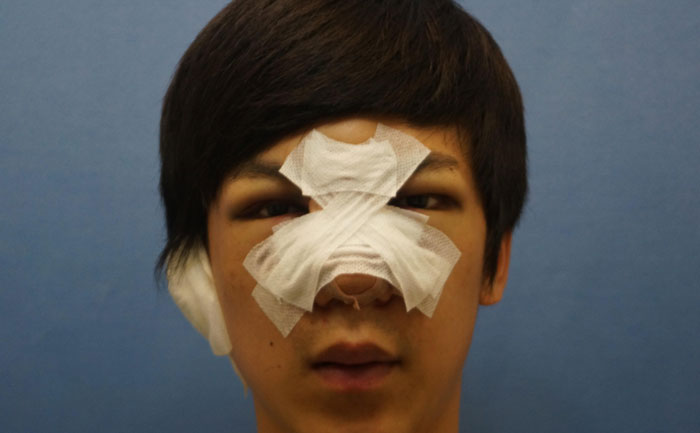 駝峰鼻矯正手術(shù)多少錢？駝峰鼻矯正有危險(xiǎn)嗎？