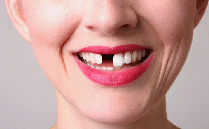 補門牙缺口大概多少錢？補門牙后一般能維持幾年？