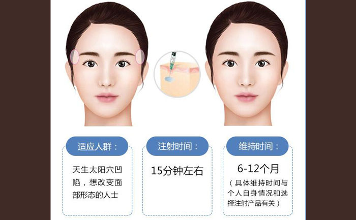 玻尿酸豐太陽穴一般幾支？