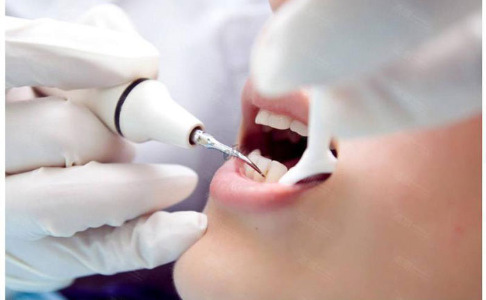 超聲洗牙價格是多少？超聲洗牙對牙齒有傷害嗎？