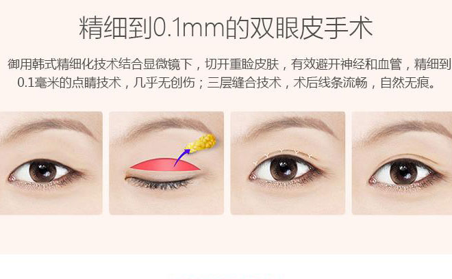 韓式三點(diǎn)雙眼皮一般要多少錢？