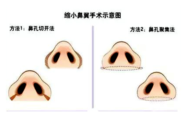  鼻翼縮小有后遺癥嗎？會(huì)不會(huì)反彈