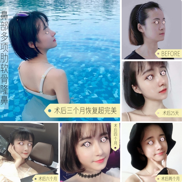 隆鼻手術(shù)